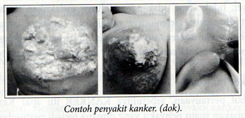Contoh Penyakit Kanker